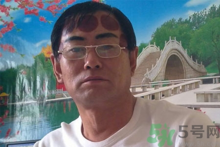 頭痛可以在額頭上拔火罐嗎？額頭上拔火罐有什么好處？