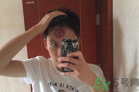 頭痛可以在額頭上拔火罐嗎？額頭上拔火罐有什么好處？