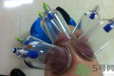 膝蓋能拔罐嗎？膝蓋疼可以拔罐嗎？
