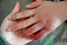生凍瘡癢怎么辦？生凍瘡很癢的時(shí)候怎么辦？