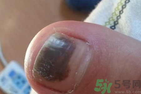 腳趾甲變黑是什么原因？腳趾甲變黑是怎么回事？