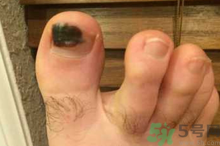 腳趾甲變黑是什么原因？腳趾甲變黑是怎么回事？