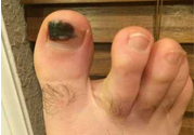 腳趾甲變黑是什么原因？腳趾甲變黑是怎么回事？