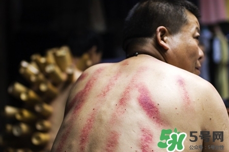 背部刮痧后能拔火罐嗎？背部刮痧后拔火罐有什么好處？