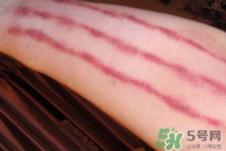揪痧和刮痧哪個(gè)效果比較好？揪痧和刮痧的區(qū)別？
