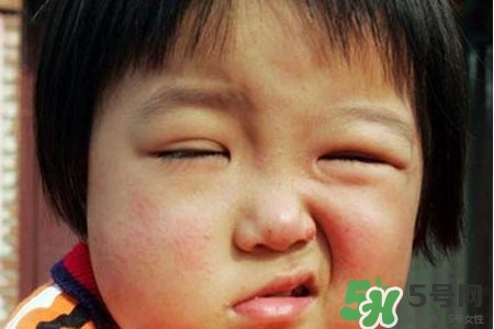 青少年面癱是怎么回事？青少年面癱是怎么辦？