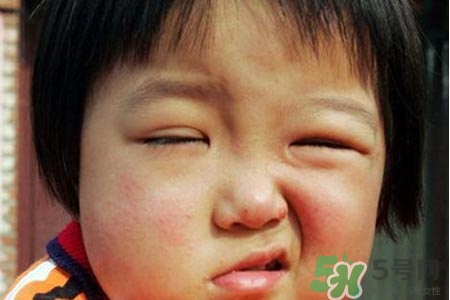 鼻炎會(huì)引起面癱嗎？鼻炎為什么會(huì)導(dǎo)致面癱？