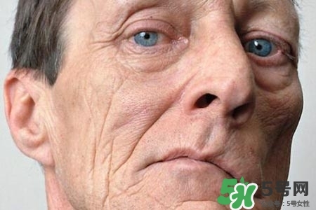 老年人為什么容易得面癱？老年人面癱原因有哪些？