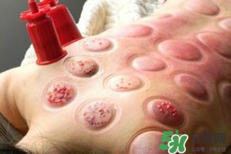 拔罐放血對身體好嗎？拔罐放血有什么好處？
