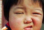 如何預(yù)防面癱復(fù)發(fā)？導(dǎo)致面癱的四大原因