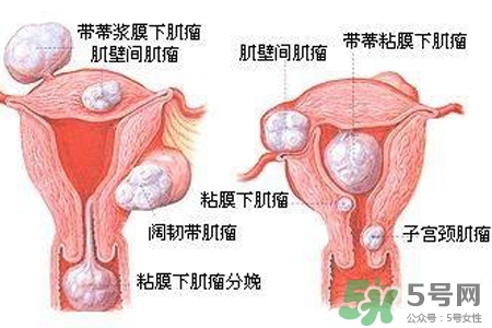 子宮小會影響生育嗎？子宮小會導(dǎo)致不孕嗎？