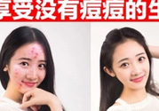 伊詩(shī)蘭頓祛痘怎么樣？伊詩(shī)蘭頓祛痘膏有用嗎？
