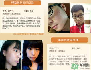 芷軒堂祛痘有效果嗎？芷軒堂祛痘印效果怎么樣？