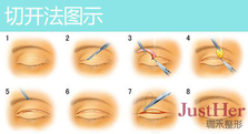 定點(diǎn)雙眼皮怎么做？定點(diǎn)雙眼皮需要拆線嗎？