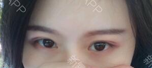 定點(diǎn)雙眼皮能保持多久？定點(diǎn)雙眼皮是永久的嗎？