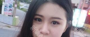 定點(diǎn)雙眼皮能保持多久？定點(diǎn)雙眼皮是永久的嗎？