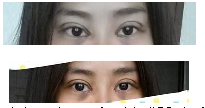 定點(diǎn)雙眼皮怎么做？定點(diǎn)雙眼皮需要拆線嗎？