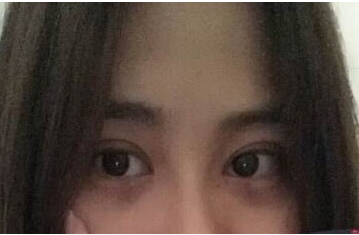 定點(diǎn)雙眼皮怎么做？定點(diǎn)雙眼皮需要拆線嗎？
