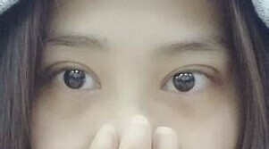 定點(diǎn)雙眼皮怎么做？定點(diǎn)雙眼皮需要拆線嗎？