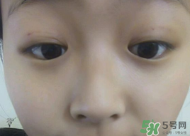 埋線雙眼皮需要拆線嗎？埋線雙眼皮怎么拆線
