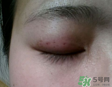 埋線雙眼皮需要拆線嗎？埋線雙眼皮怎么拆線