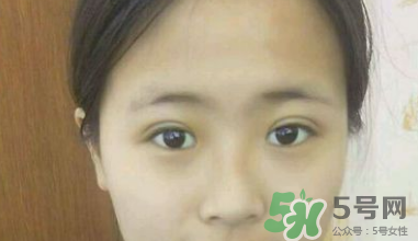 埋線雙眼皮需要拆線嗎？埋線雙眼皮怎么拆線