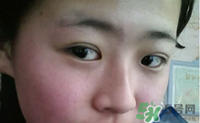 埋線雙眼皮需要拆線嗎？埋線雙眼皮怎么拆線