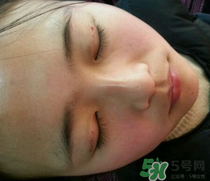 埋線雙眼皮需要拆線嗎？埋線雙眼皮怎么拆線