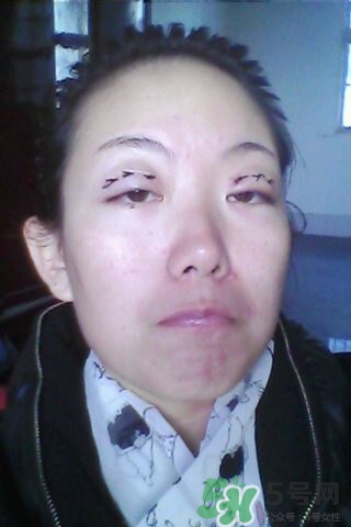 什么是定點雙眼皮？定點雙眼皮多少錢？