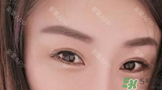 埋線雙眼皮能保持多久？埋線雙眼皮是永久嗎