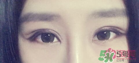 切開(kāi)雙眼皮多久消腫？切開(kāi)雙眼皮多久恢復(fù)？