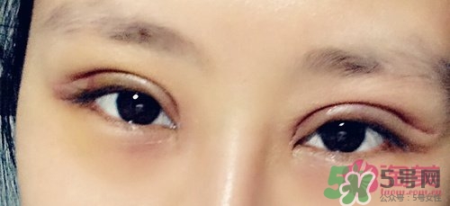 切開(kāi)雙眼皮多久消腫？切開(kāi)雙眼皮多久恢復(fù)？