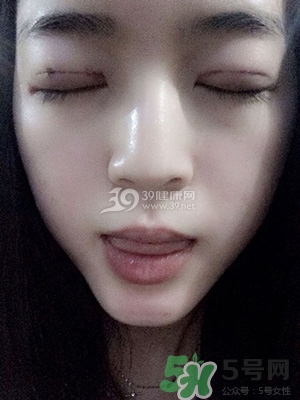 什么是定點雙眼皮？定點雙眼皮多少錢？