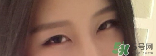 切開(kāi)雙眼皮多久消腫？切開(kāi)雙眼皮多久恢復(fù)？
