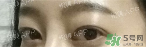 埋線雙眼皮多久恢復(fù)自然？埋線雙眼皮多久能恢復(fù)