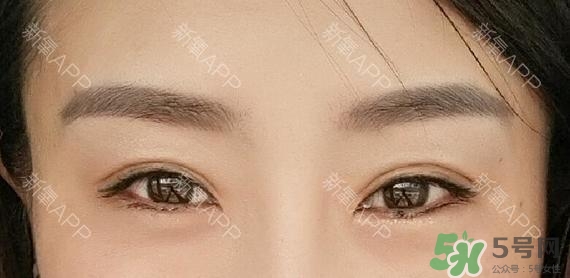埋線雙眼皮能保持多久？埋線雙眼皮是永久嗎
