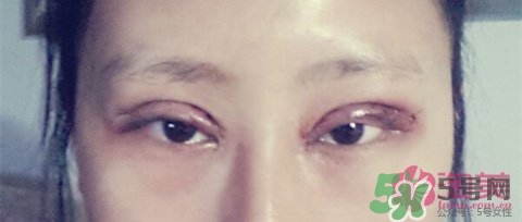 切開(kāi)雙眼皮多久消腫？切開(kāi)雙眼皮多久恢復(fù)？