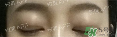 埋線雙眼皮多久恢復(fù)自然？埋線雙眼皮多久能恢復(fù)