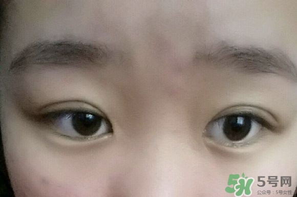 埋線雙眼皮需要拆線嗎？埋線雙眼皮怎么拆線