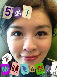 重瞼術(shù)是什么？重瞼術(shù)是永久的嗎？