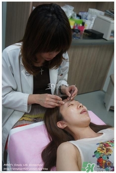 重瞼術(shù)多久能完全消腫 重瞼術(shù)恢復過程圖