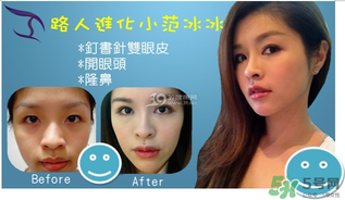 重瞼術(shù)是什么？重瞼術(shù)是永久的嗎？