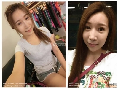 重瞼術(shù)多久能完全消腫 重瞼術(shù)恢復過程圖