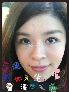 重瞼術(shù)是什么？重瞼術(shù)是永久的嗎？