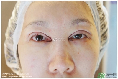 重瞼術(shù)多久能完全消腫 重瞼術(shù)恢復過程圖