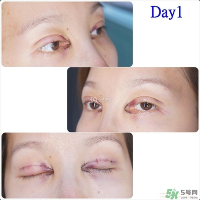 重瞼術(shù)多久能完全消腫 重瞼術(shù)恢復過程圖