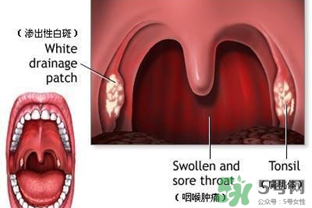 霧霾天喉嚨痛怎么辦？霧霾天嗓子疼怎么辦？
