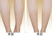 小腿吸脂多久見效？小腿吸脂后多久能看見效果？