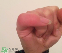 小拇指凍腫了怎么辦？為什么小拇指容易凍？