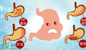 神經(jīng)性胃痙攣是什么？神經(jīng)性胃痙攣是什么原因？